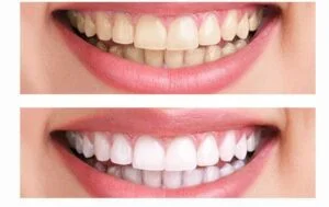 Teeth Whitening-02