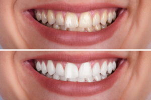 Teeth Whitening-03