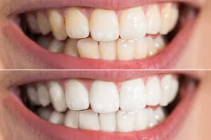 Teeth Whitening-05